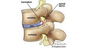 Disc Herniation